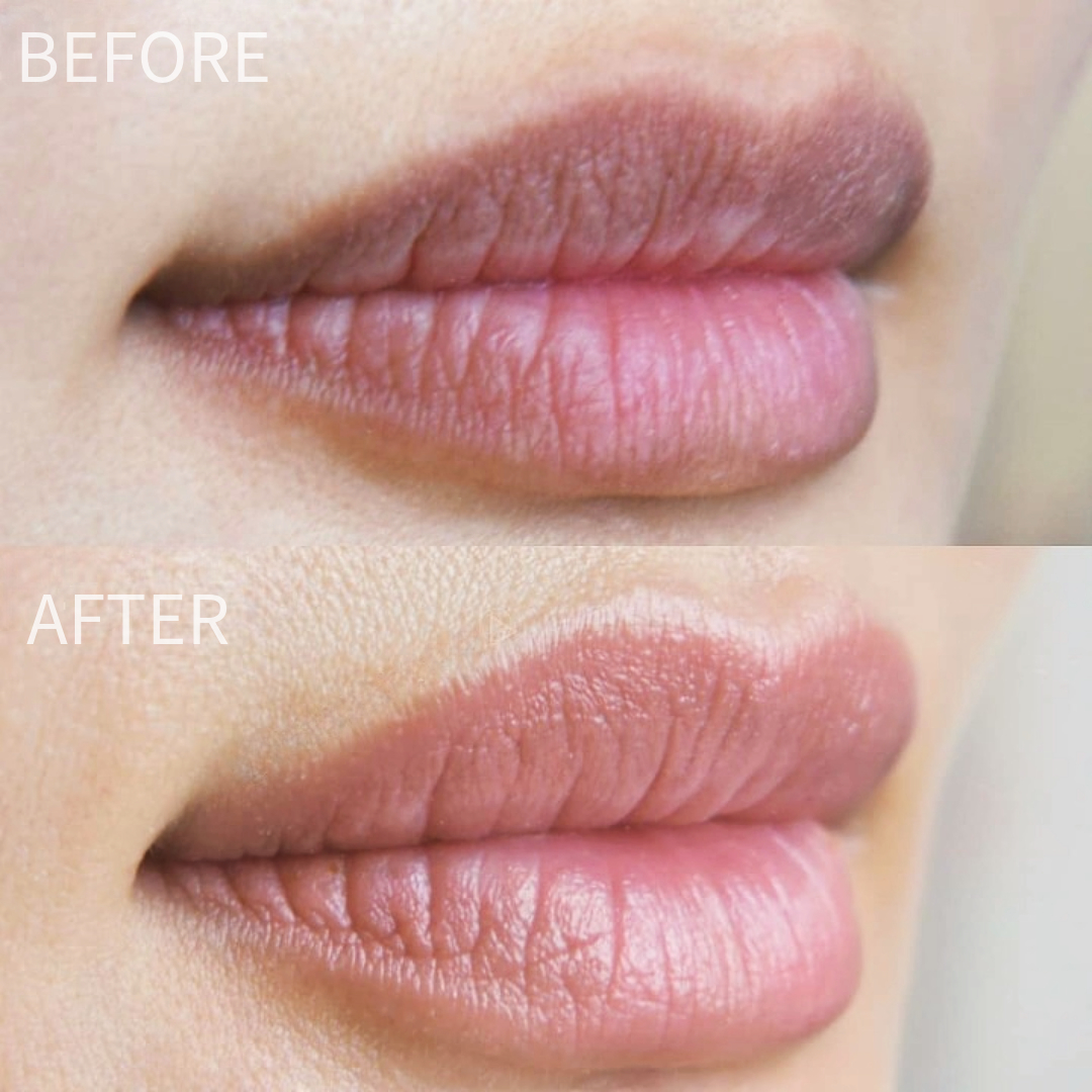 Dark Lip Neutralization