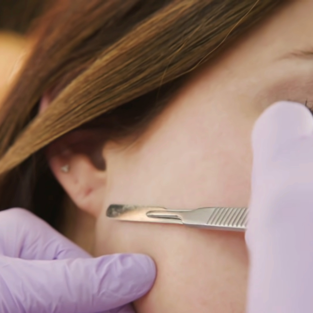 dermaplaning