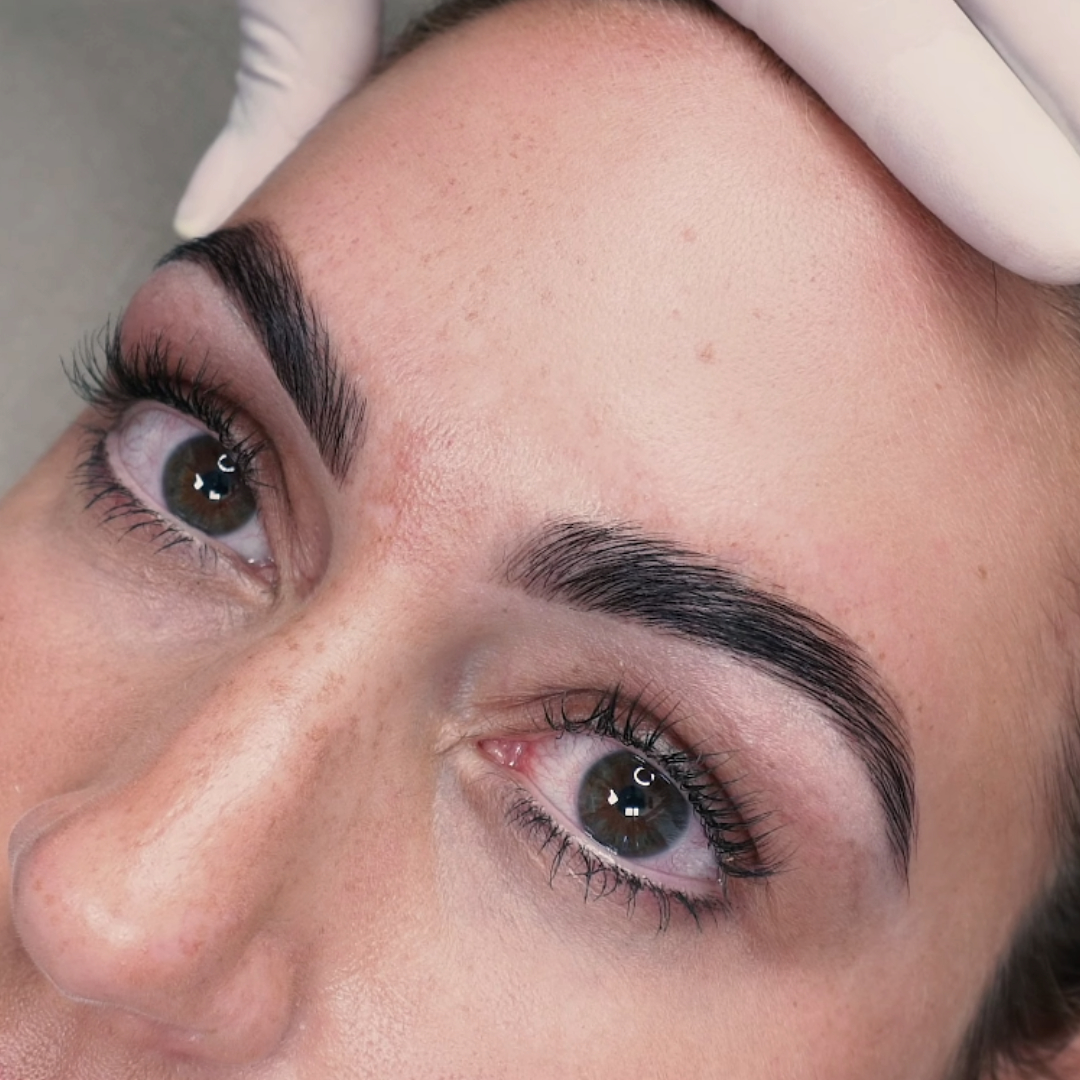 Hollywood brow lift