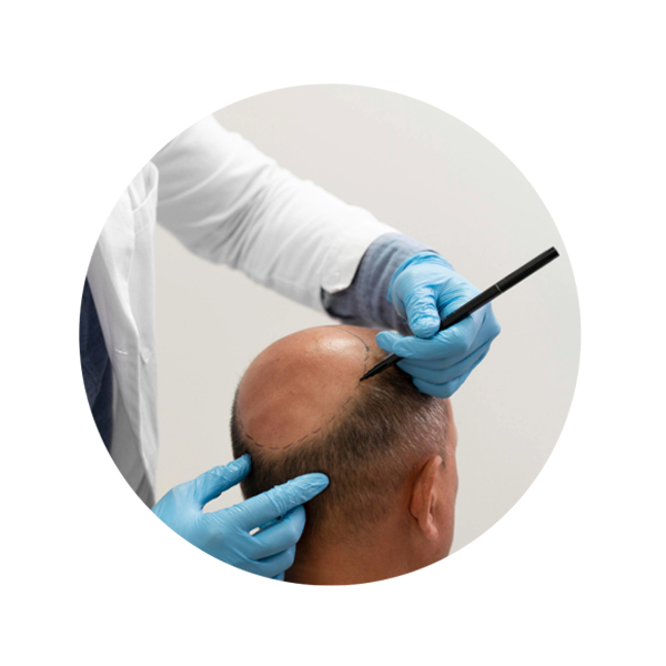 Scalp Micropigmentation